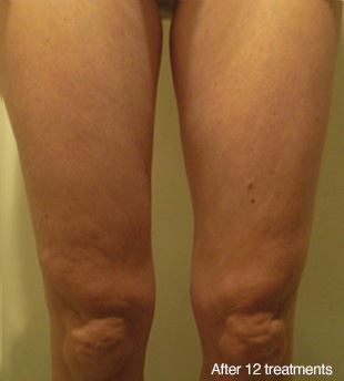 therapy contour fat legs does sculpting reduction sessions treatments loss weight sculpt renew tanning boutique